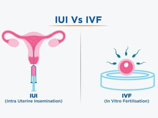 IUI và IVF khác nhau thế nào? Khi nào bác sĩ cân nhắc từng phương pháp?